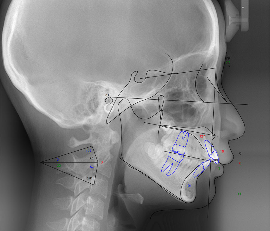 頭部X線規格写真