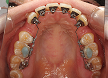 リンガルブラケット