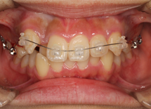 デーモンクリア