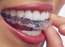 インビザライン