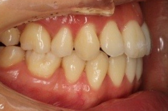 大人の矯正 After