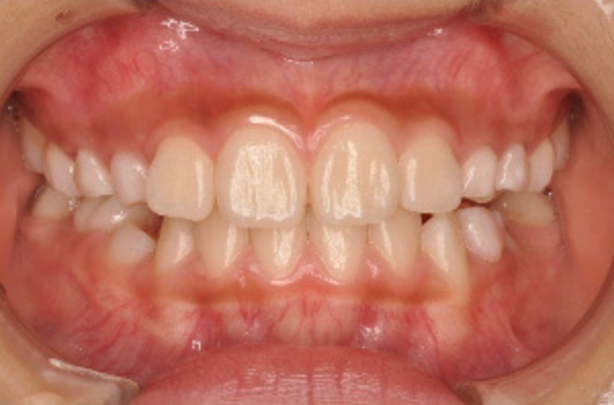 子どもの矯正 After