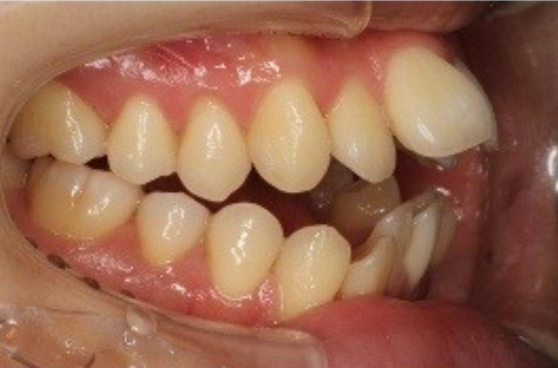 大人の矯正 Before