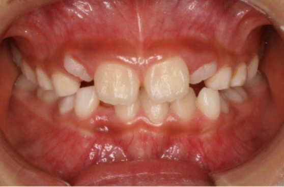 子どもの矯正 Before