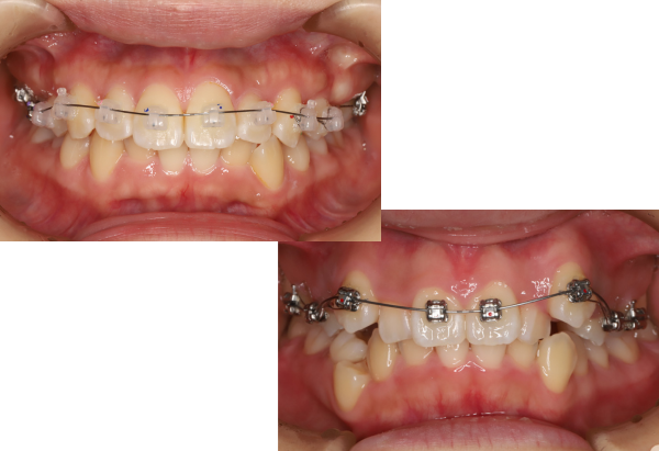 img - 2025-11-19T154805.864 ブラケット