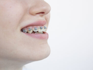 22165677_s 矯正している女性