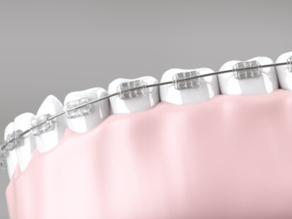 23179124_s 矯正器具が付いた歯